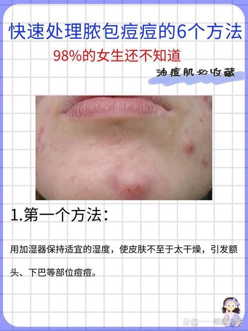 脓包痘痘怎么处理不反复？怎样防止脓包痘痘复发？